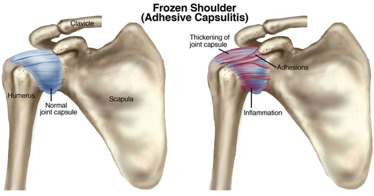 Frozen Shoulder Physio Treatment