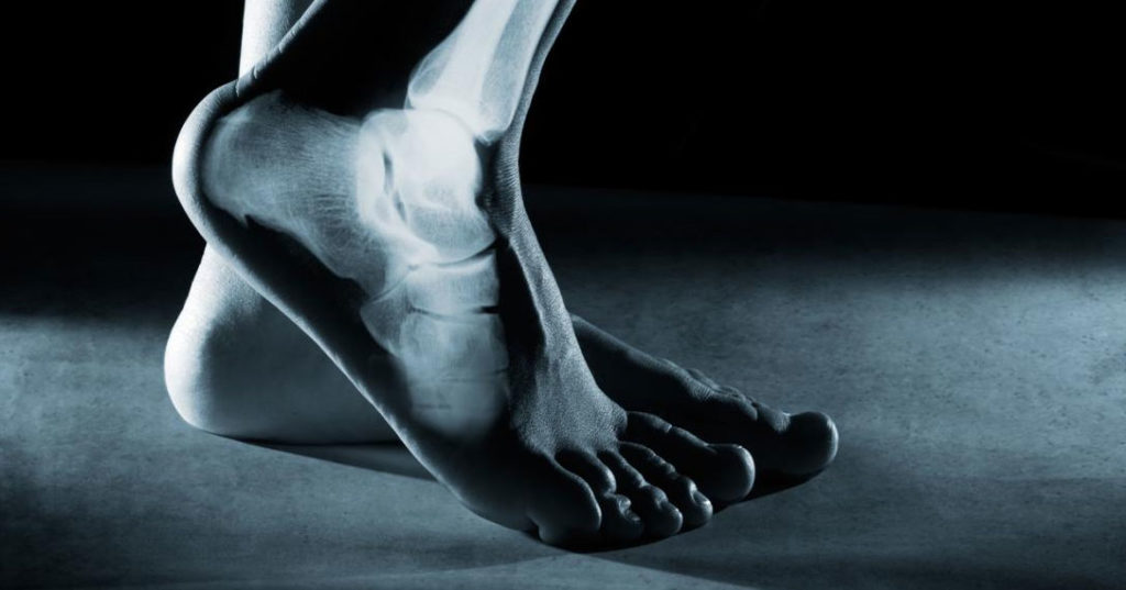 Foot Stress Fracture And Podiatry