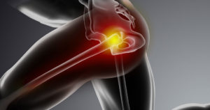 Hip Impingement Diagnosis And Treatment