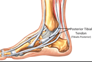 Posterior Tibial Tendon Dysfunction