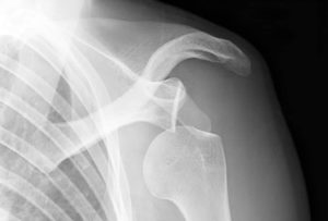 Shoulder Instability And Physio Rehab