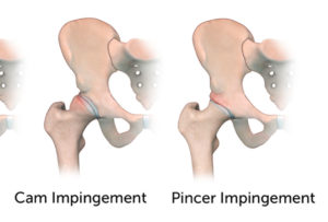 What Is Femoroacetabular Impingement