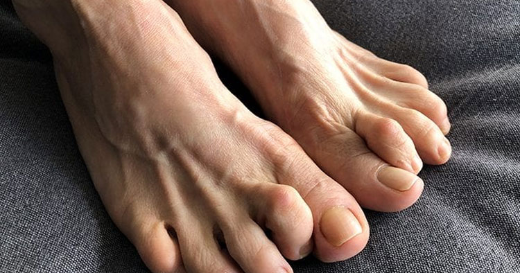 Do You Have Crooked Toes?