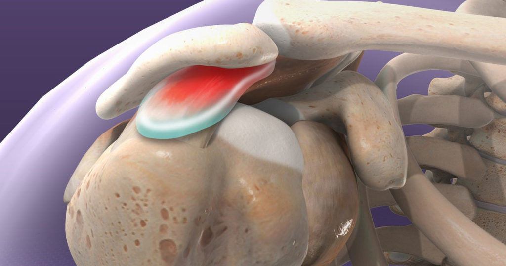 Shoulder Bursitis, A Shoulder Physio Approach