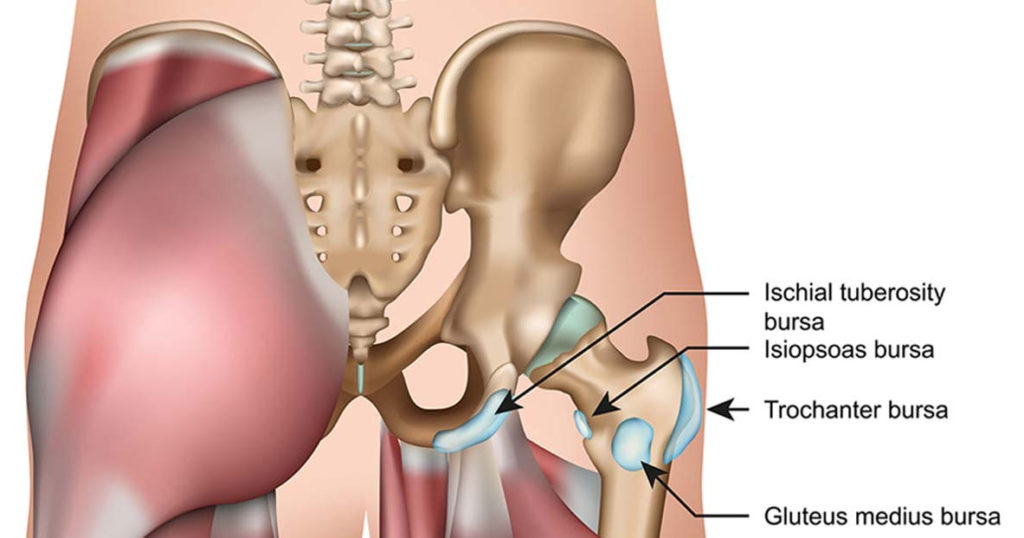 Trochanteric Bursitis Of The Hip