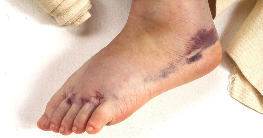 An Ankle Sprain Explained
