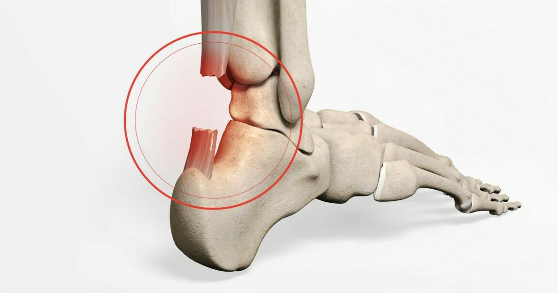 Sports Injury Bulletin - Anatomy - Principles of tendon healing apply to  the Achilles tendon