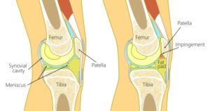 Fat Pad Syndrome As A Cause Of Knee Pain