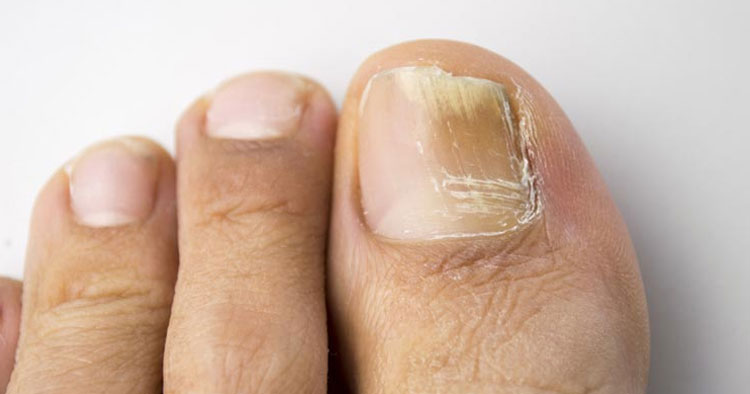 Fungal Nails Thickened And Discoloured Nails