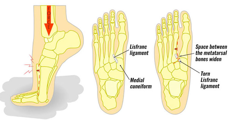 Lisfranc Injury In The Foot