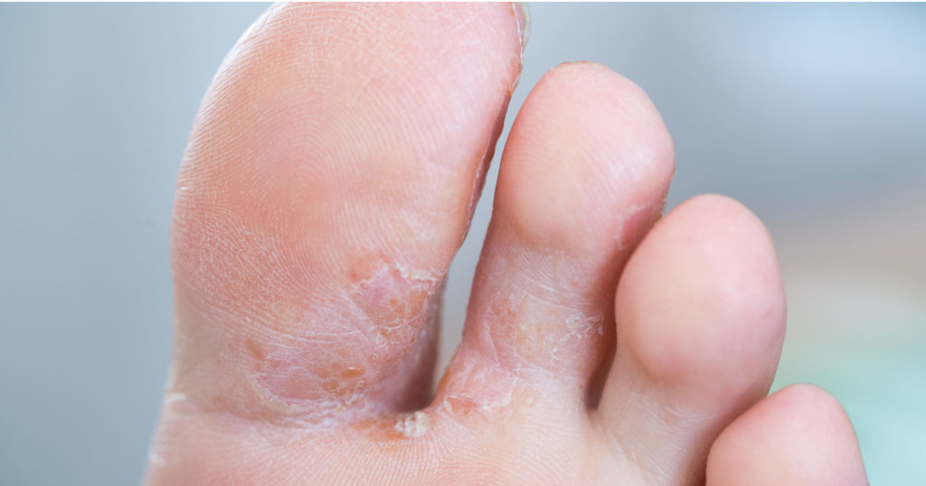 Athletes Foot Also Known As Tinea