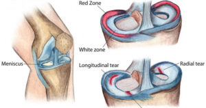 The Meniscus Of The Knee Joint
